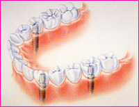 インプラント